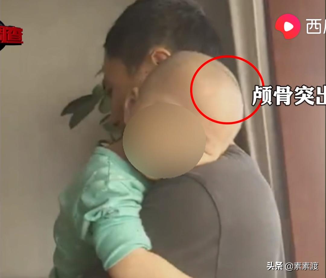 小儿喝假奶粉成大头娃娃,假奶粉吃成大头娃娃