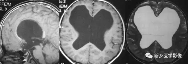 脑室为什么会扩张,脑室为什么会变小