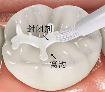 已经有龋齿了还可以做窝沟封闭吗,幼儿龋齿窝沟封闭护理措施