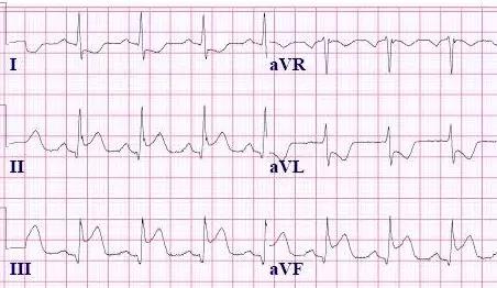 常见心梗特殊心电图,各部位心梗心电图详解