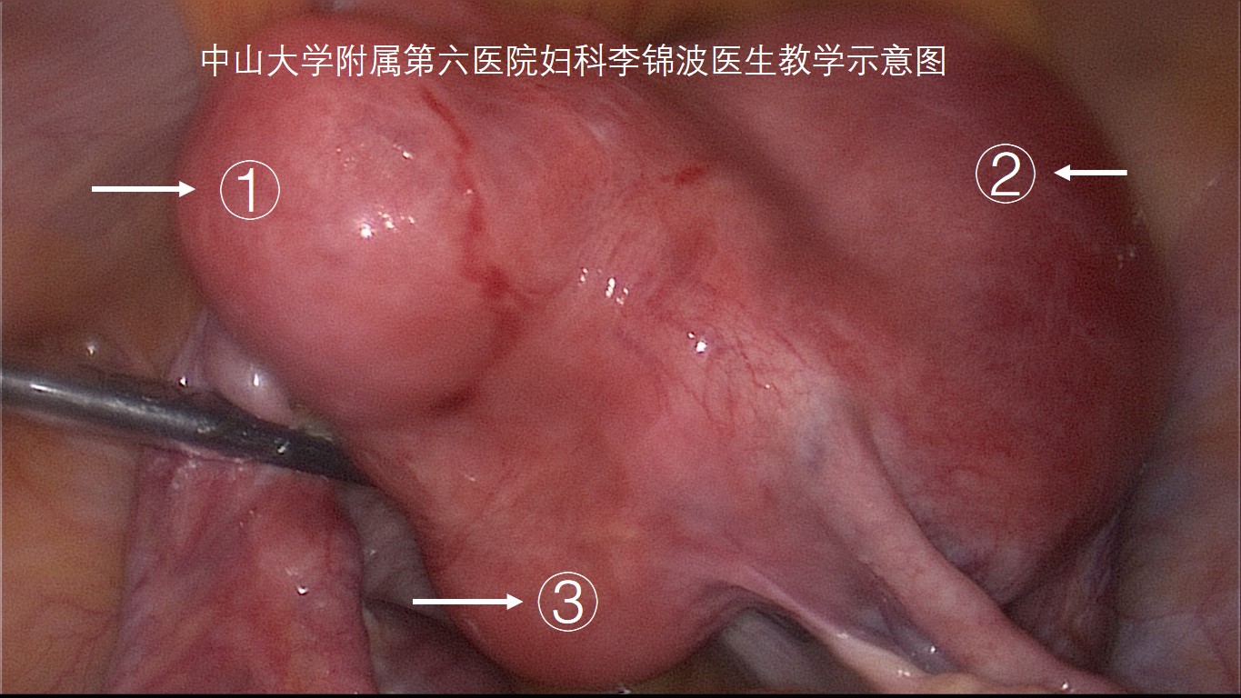 子宫肌瘤是不是必须做手术,子宫肌瘤做微创好还是手术开刀好