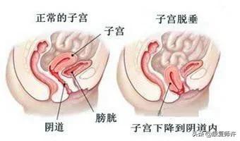 产后腹直肌分离的解决方法,产后腹直肌分离怎么处理