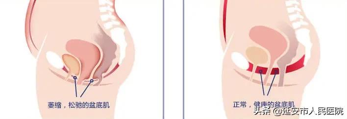 延安市第四人民医院盆底修复,延安市医院李爱明