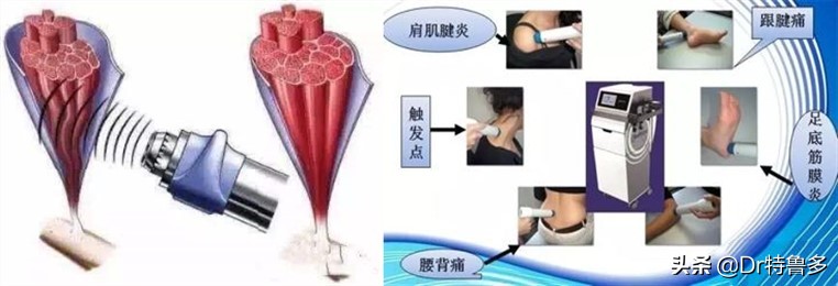 骨折了不长、长得慢怎么办?试试冲击波治疗吧