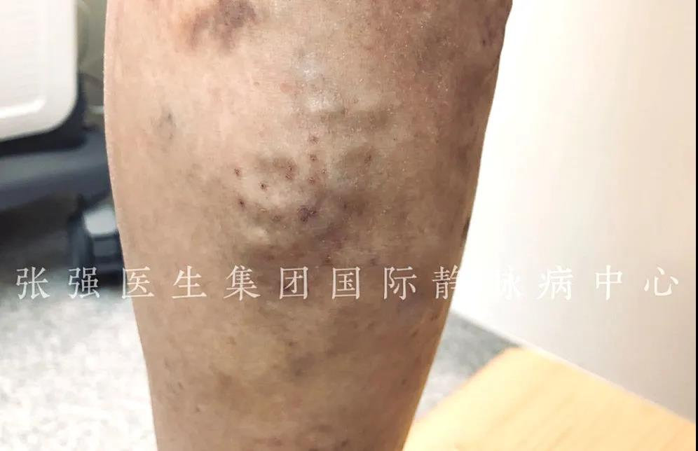 静脉曲张扎针放血成功案例,苏磊谈静脉曲张手术过程