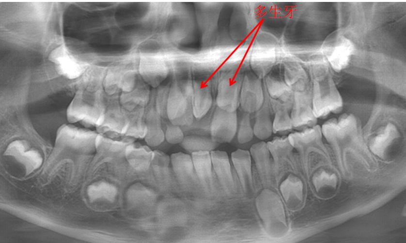 10岁孩子牙掉1年还不长,孩子不长牙了怎么办