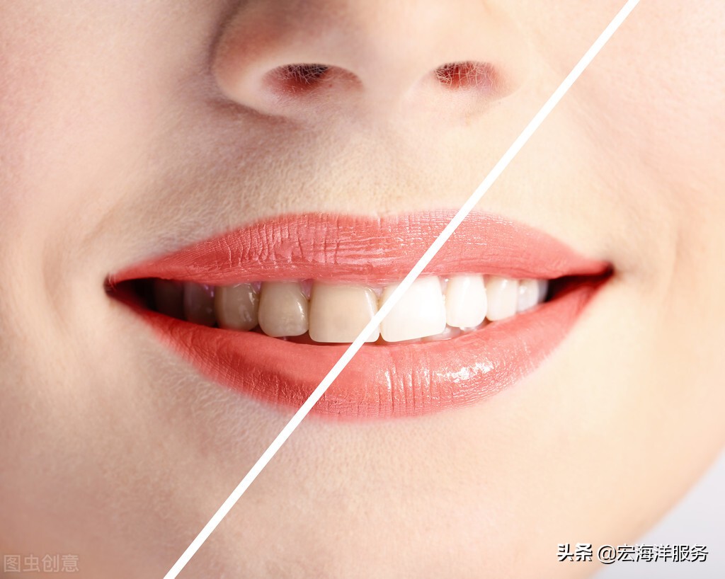 快速美白烟渍牙齿,快速美白牙齿小妙招白醋