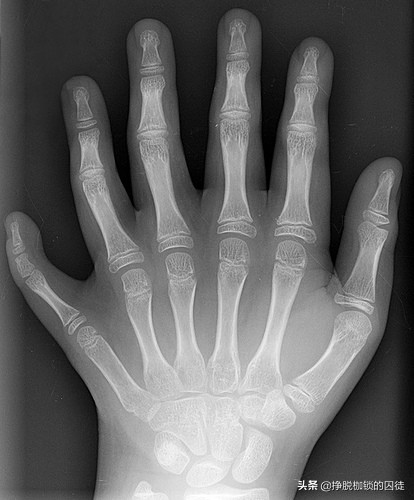 六指一般多出哪一个手指,六指多出的手指叫什么