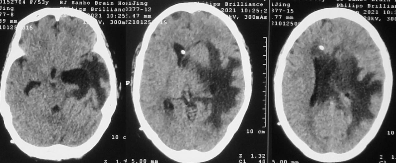 脑脓肿合并脑膜炎需要手术吗,脑脓肿进入左侧脑室严重吗