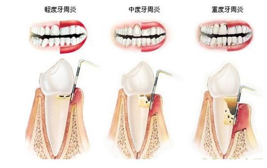 口臭刷牙牙龈出血是什么原因,刷牙流血口臭算不算重度牙周炎