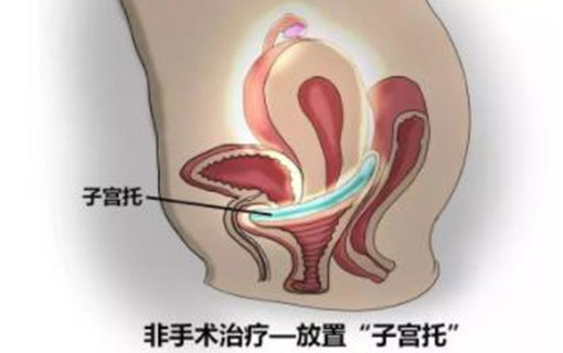 难以启齿，她每次排便需要把手伸入阴道，医生说这是病得治