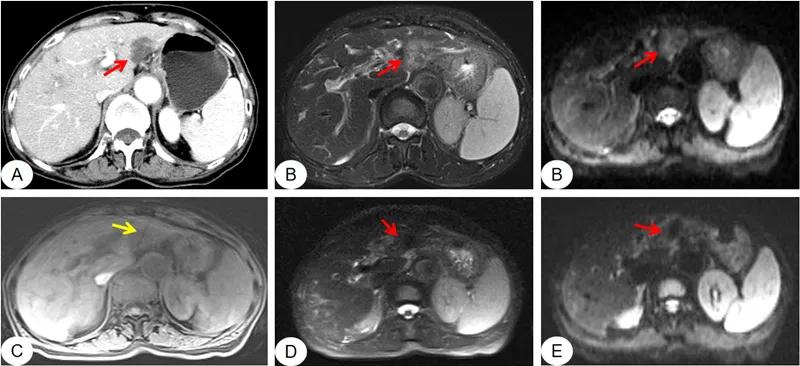 磁共振作用与效果,磁共振成像的优势有