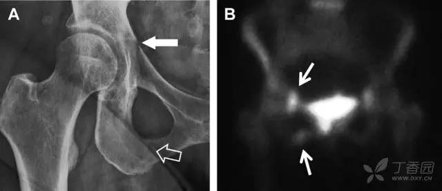 常见的八种骨折,容易漏诊的肩关节骨折