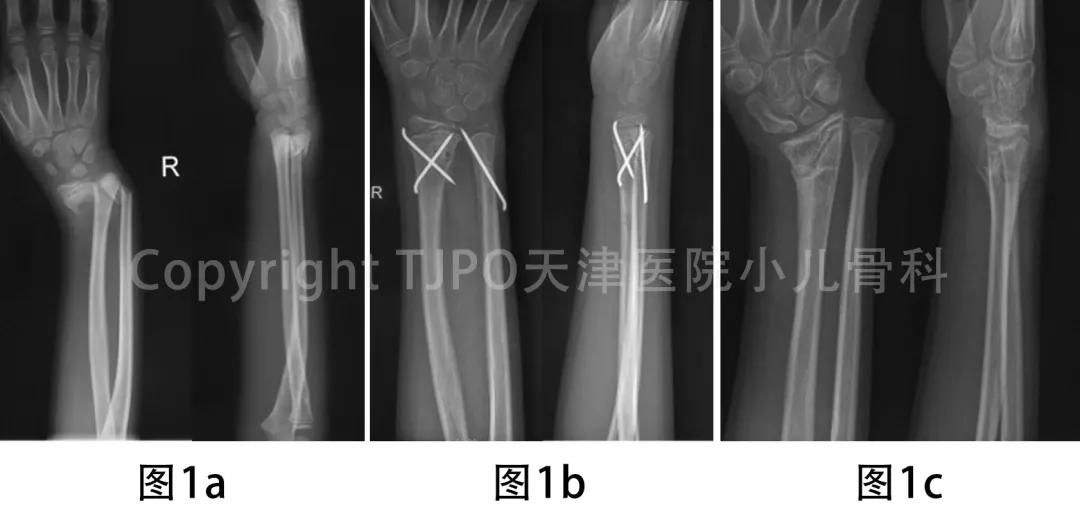 桡骨小头畸形截骨矫形,小儿尺桡骨远端发育迟缓畸形