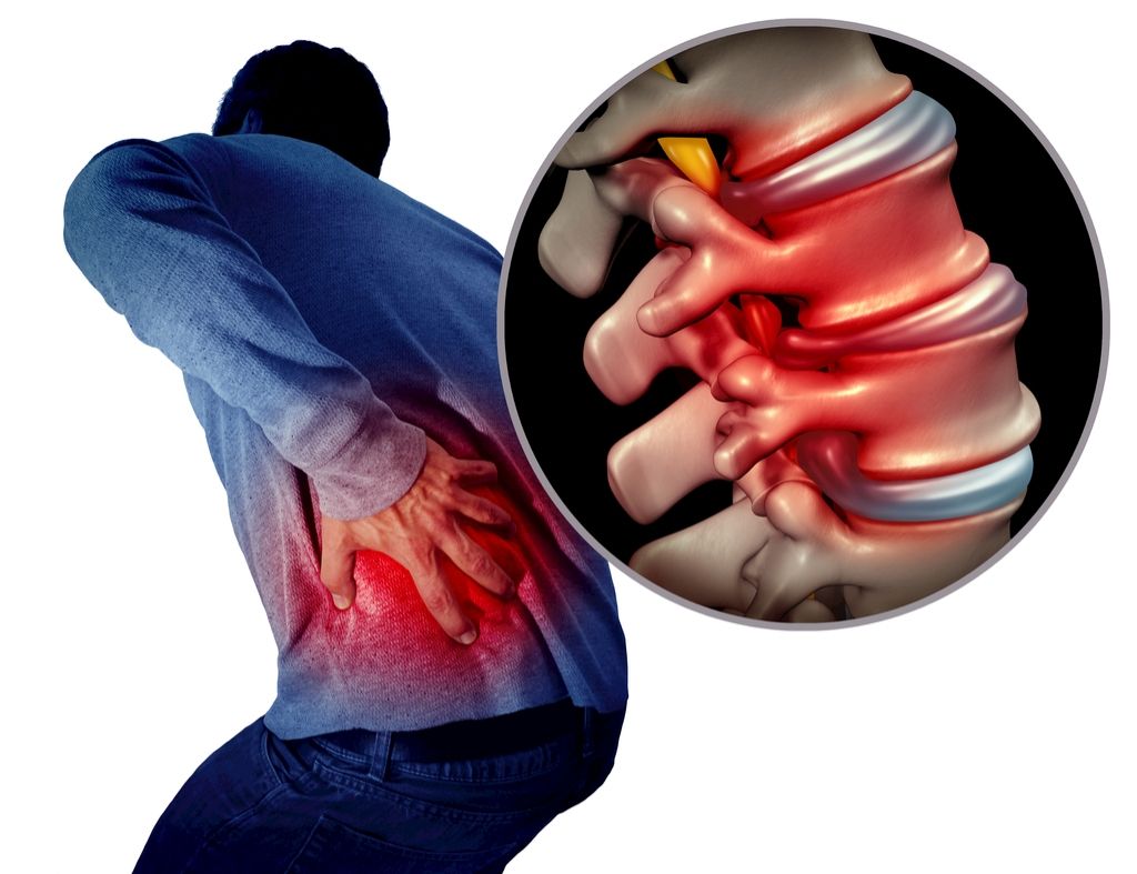 20岁腰椎间盘突出自愈案例,20岁腰椎间盘突出保守治疗