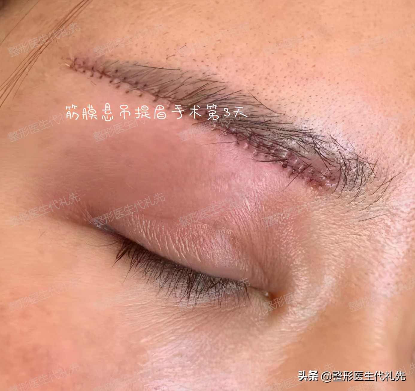 50岁做提眉眼袋手术能保持多久,提眉去眼袋手术15天图片