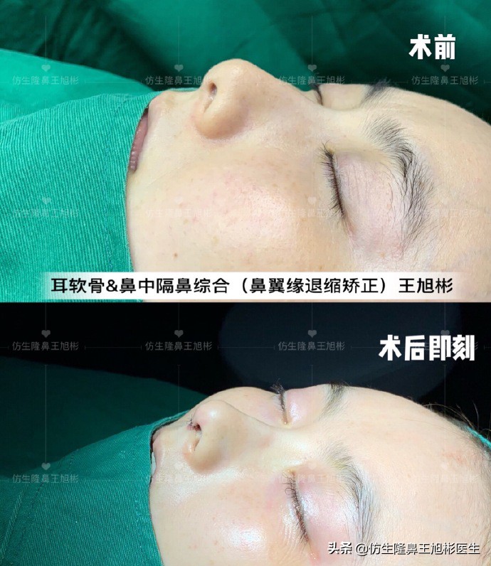 王旭彬:朝天鼻、露鼻孔,模特菲菲短鼻矫正手术后1.5个月