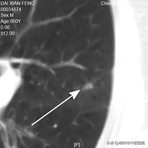 肺癌陀螺刀放疗后五年生存率,得了肺癌是不是不要轻易动手术