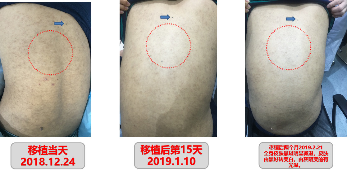 深圳肠道菌群移植有几家医院能做,肠道菌群移植医疗技术