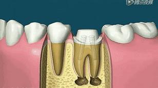 大连口腔视频,大连市口腔医院根管治疗