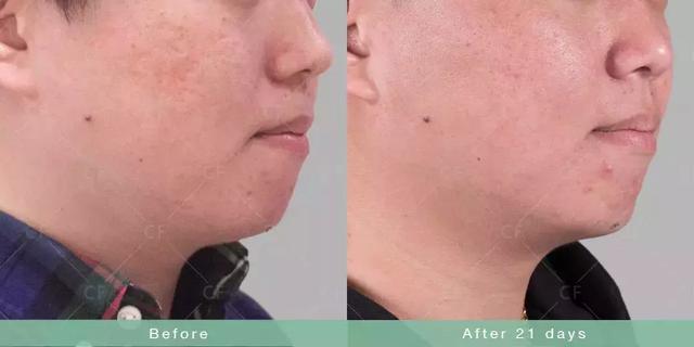 如何瘦双下巴和婴儿肥,小孩怎么快速减掉双下巴