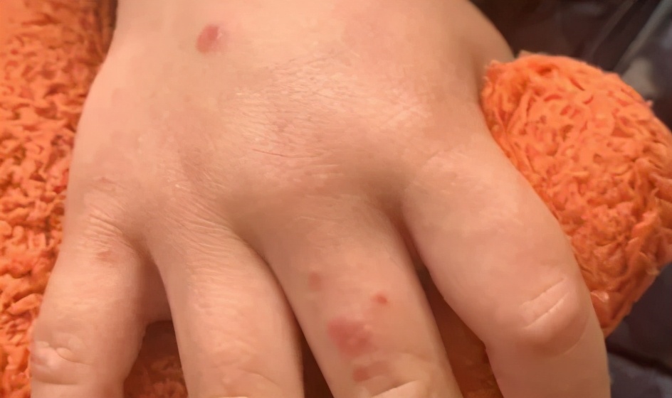 宝宝指甲有白斑倒刺缺什么元素,孩子指甲出白点是缺钙吗