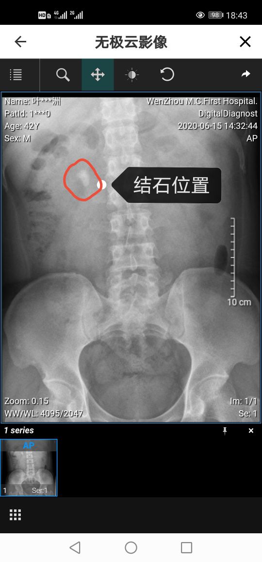 刷新了对疼痛的认知～我的肾结石手术经历