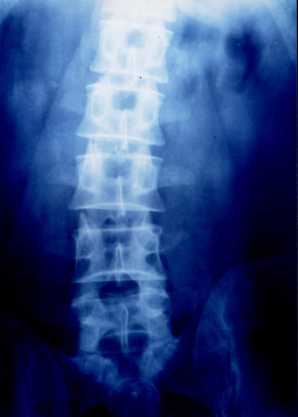 腰椎间盘突出针灸能治彻底吗,腰椎间盘突出针灸治疗能彻底吗