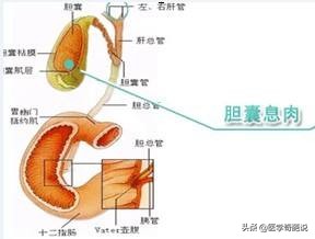 多发性胆囊息肉1.0癌变几率大吗,胆囊息肉几年没有长大需切除吗