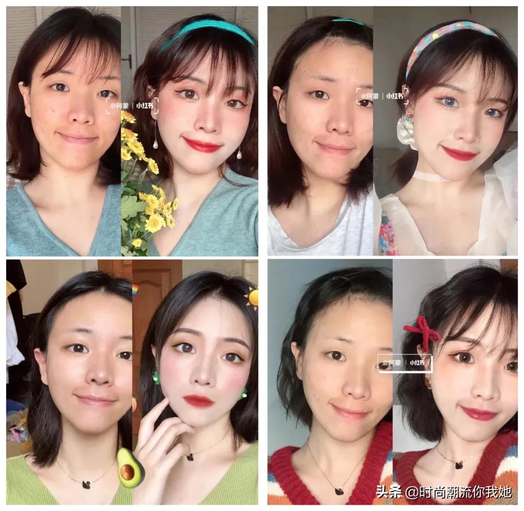 单眼皮凸嘴素人改造,肿眼泡整容成功案例