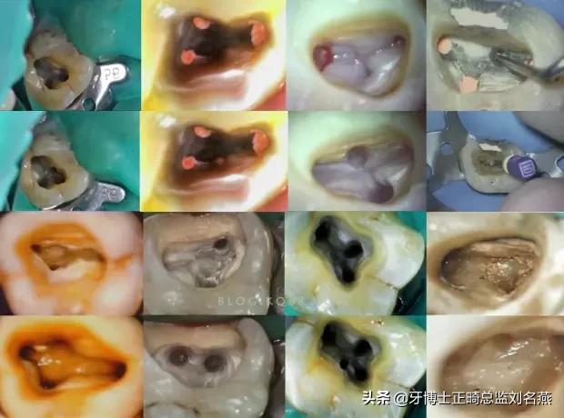 根管治疗难点与解决方案,根管治疗牢固吗