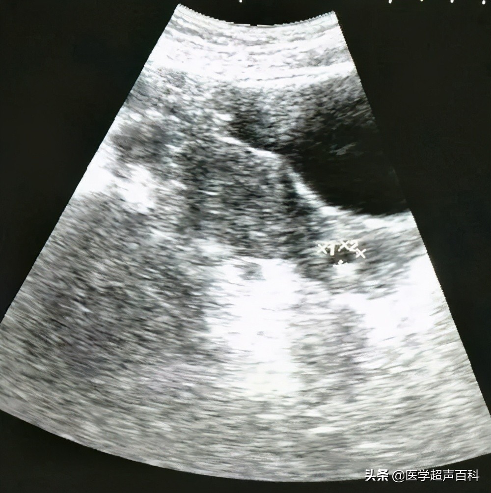 体检时发现宫颈囊肿,体检考虑为宫颈囊肿会影响怀孕么