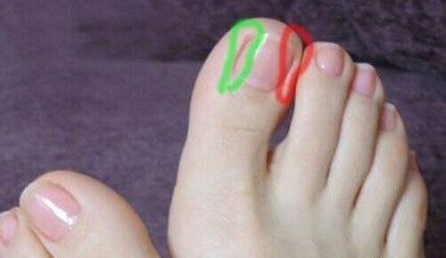 甲沟炎去修脚店要留指甲吗,脚指甲有甲沟炎怎么处理