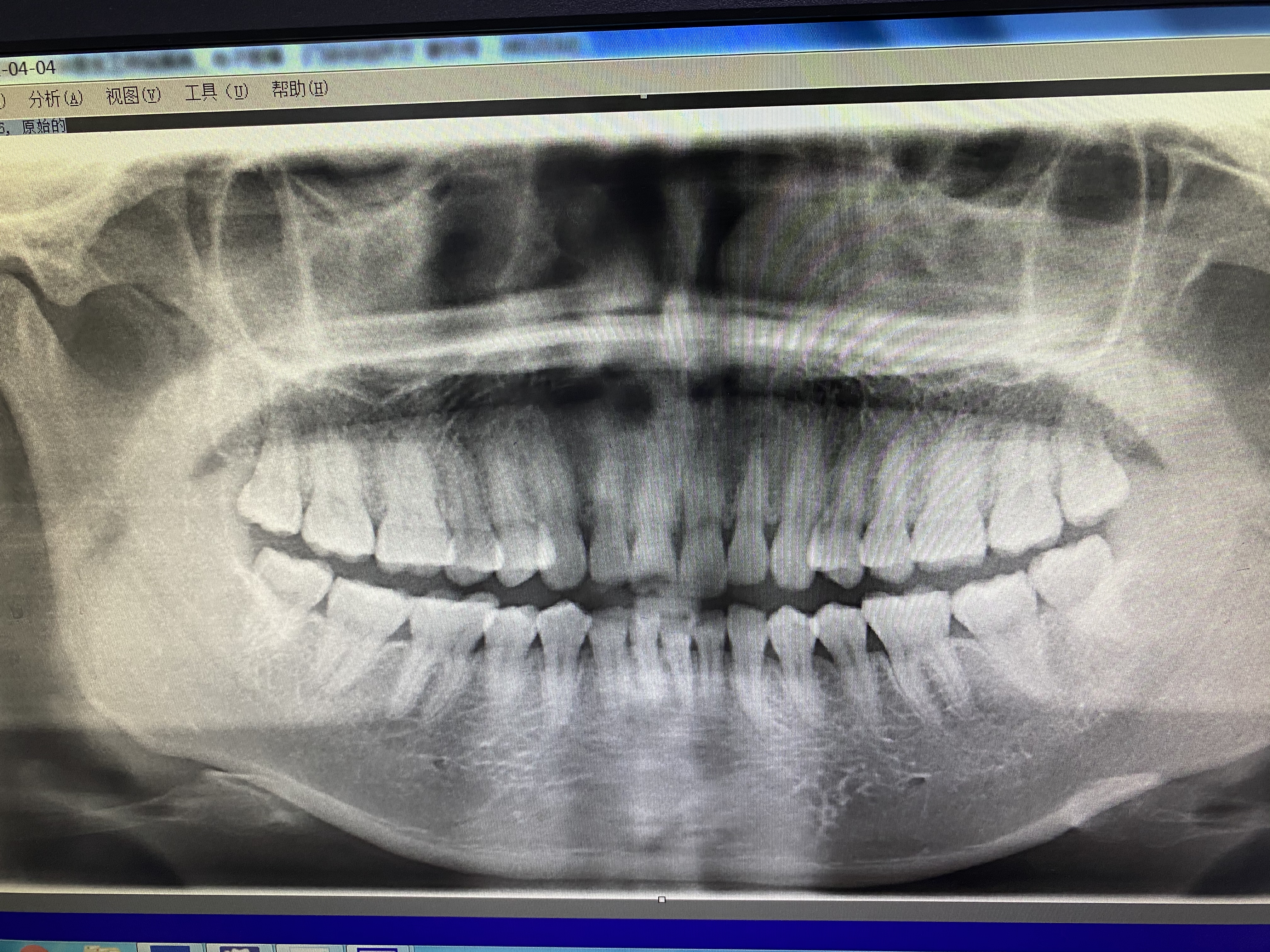 已经完全长的智齿拔牙全过程,智齿拔牙全过程病例分享