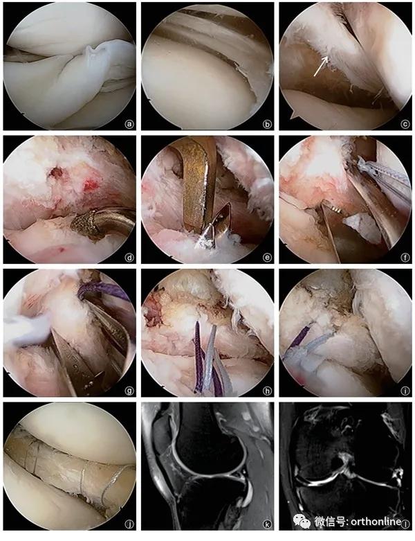 关节镜下治疗症状性Wrisberg韧带型盘状半月板的临床疗效