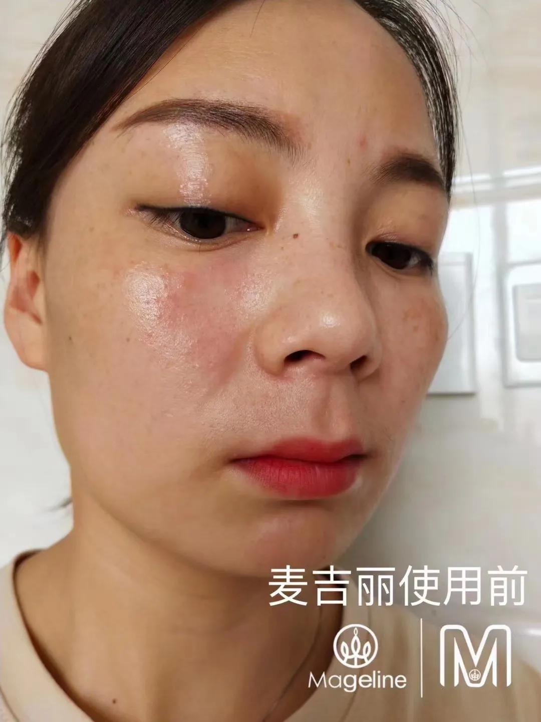 甜甜专业祛斑祛痘,甜甜祛斑直播间