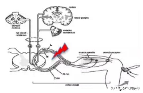 痉挛性脑瘫患儿心理康复方法,痉挛型脑瘫智力障碍
