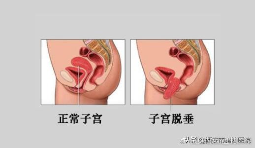 预防子宫脱垂患者的运动,产后如何预防子宫脱垂