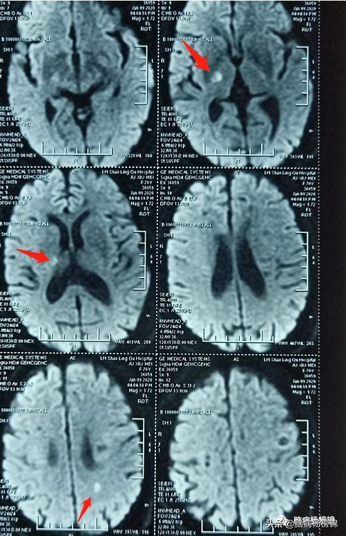 脑出血和脑梗塞同时出现已经昏迷,急性脑梗塞和急性脑出血同时出现