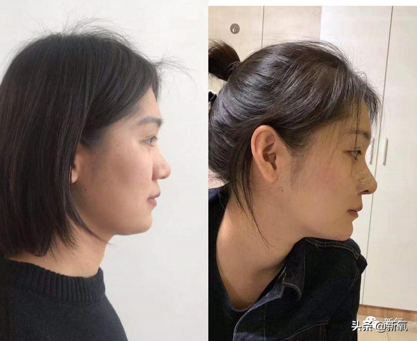 鞠婧祎鼻子有多漂亮,如何变成鞠婧祎同款鼻子