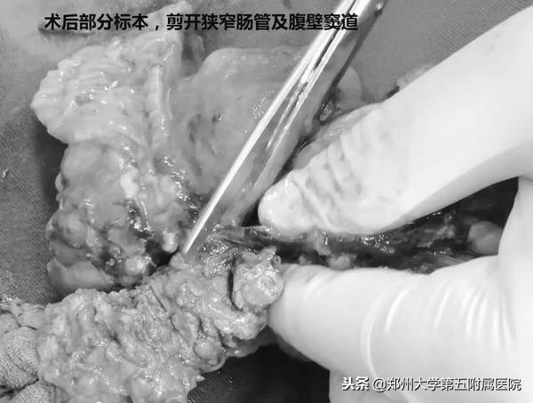 十来年肠绞痛的表现和处理方法,十年腹痛