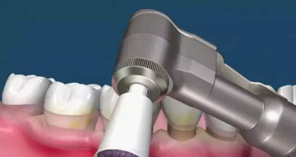 洗牙到底怎么洗好,洗牙洗的不干净