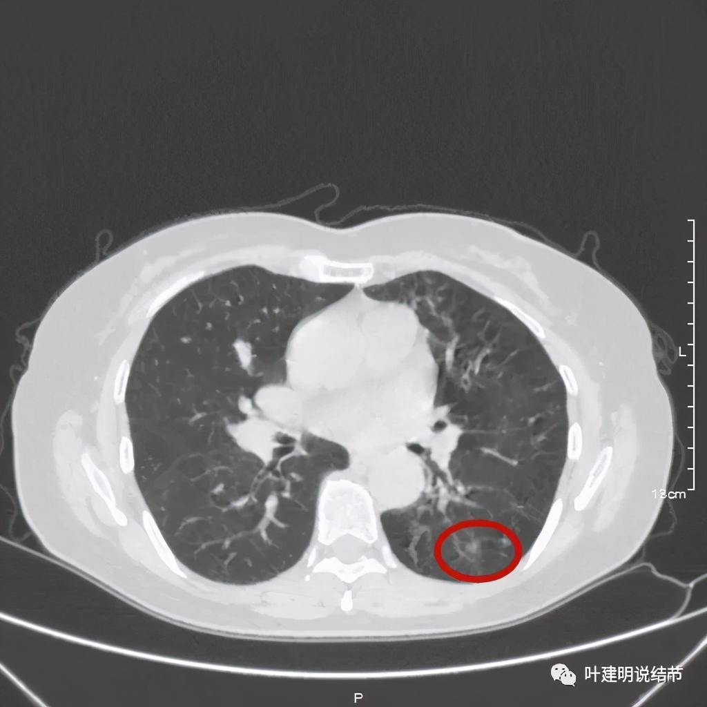 这样的实性结节伴小空洞会是肺癌吗?