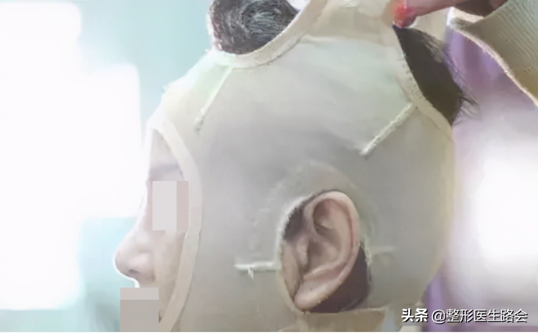 去除法令纹要先打苹果肌吗,去除法令纹可以打除皱针吗