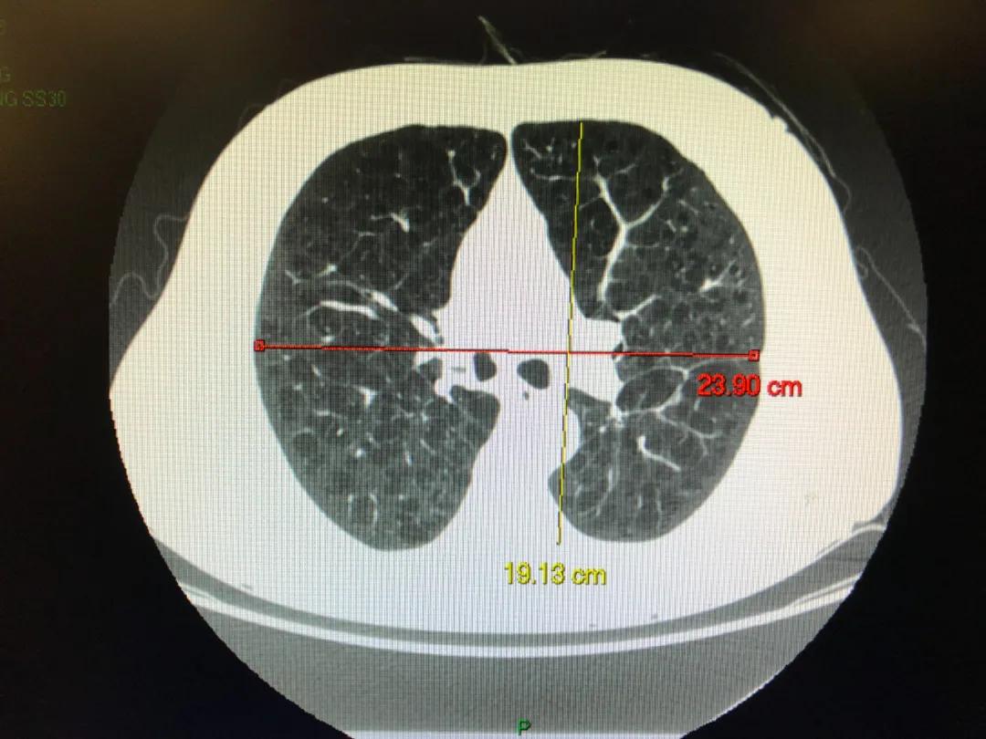 慢阻肺是桶状胸,慢阻肺会出现桶状肺吗