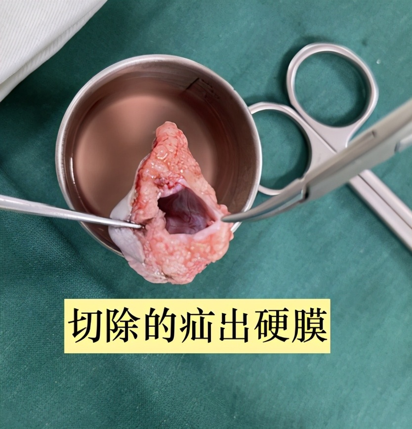 脊柱裂脊髓栓系手术恢复过程,脊柱裂与脊髓脊膜膨出的区别