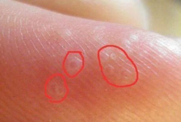 4个习惯加重体内湿气尽早改掉,手上全是小水泡如何祛湿