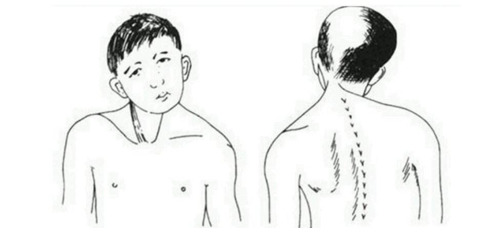 大夫告诉我痉挛性斜颈怎么治疗？