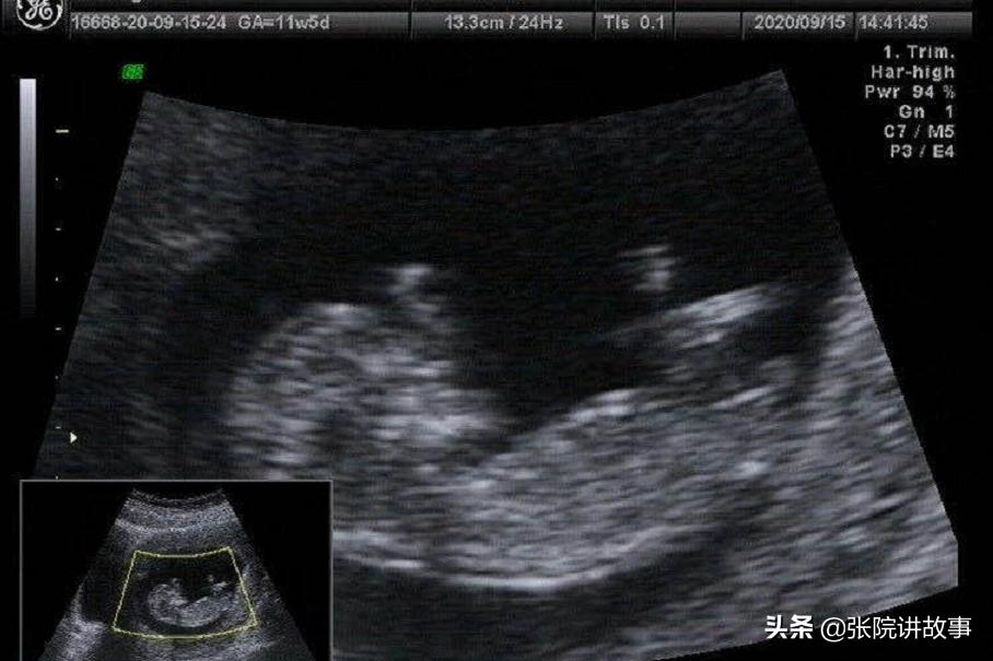 「张院讲故事」子宫肌瘤：名中带“瘤”，真的非常可怕吗？