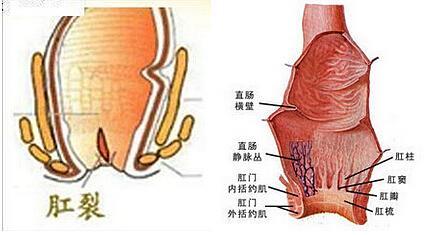 哪些原因会导致肛裂,什么原因能导致肛裂